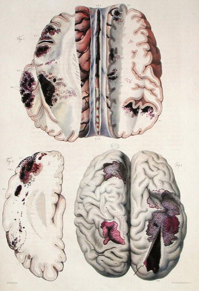 Kapillær apopleksi, fra "Anatomie Pathologique du Corps Humain" af Jean Cruveilhier (1791-1874) 1828-42 (farvestik) af Antoine Chazal
