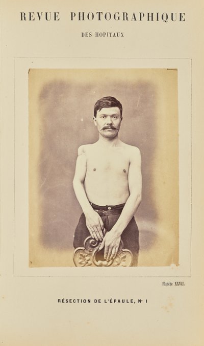 Skulderresektion, nummer 1 af Arthur de Montmeja