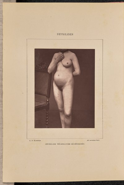 Generaliseret vesikulær syfilis af Arthur de Montmeja