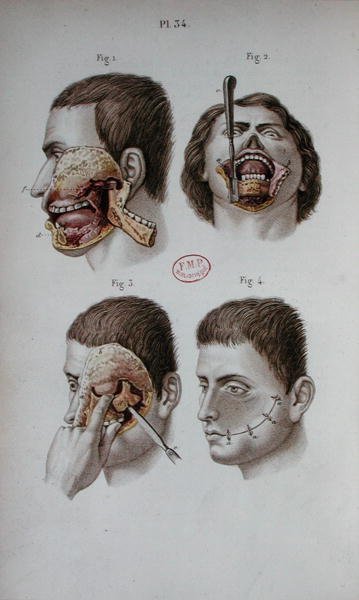 Anatomisk plade af overkæben af C and Huette E. Bernard