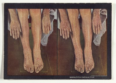 Dermatitis Exfoliativa af Dr. Selden I. Rainforth