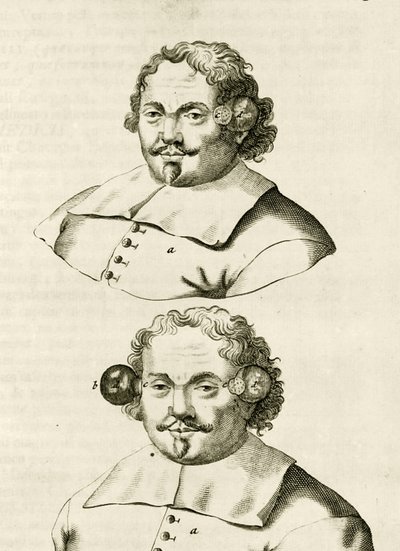 Et eksempel på cupping, fra The Practice of Medicine af Frederik Dekkers, 1694 af Dutch School