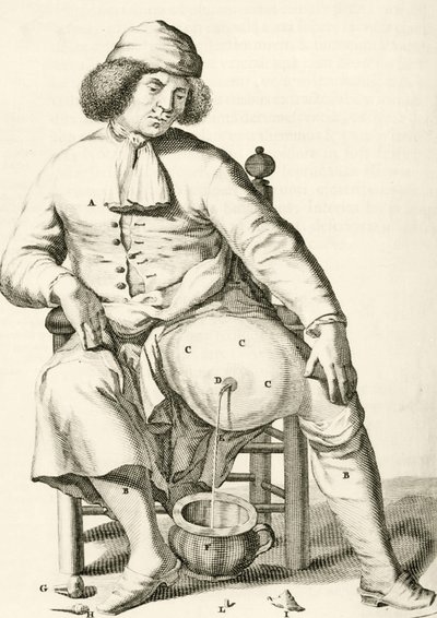 Dræning af væske fra en byld af Frederik Dekkers, 1694 af Dutch School