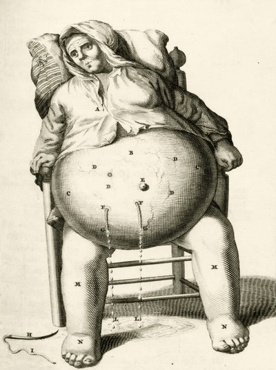 Dræning af væsker fra en byld af Frederik Dekkers, 1694 af Dutch School