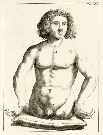 Eksempel på medfødte misdannelser af Frederik Dekkers, 1694 af Dutch School