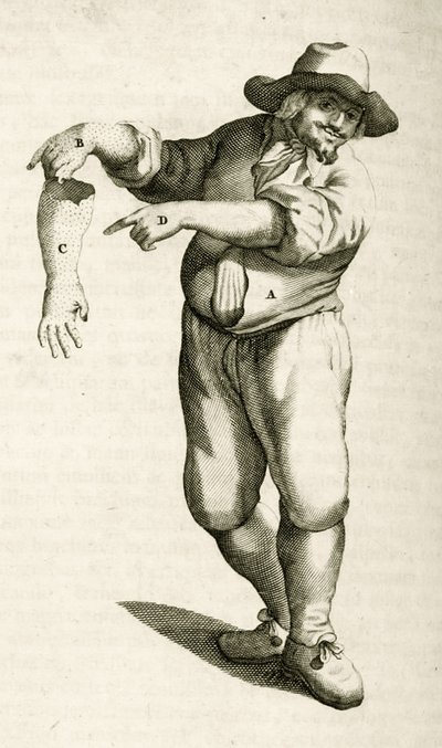 Fjernelse af død hud med pustler, fra Practical Exercises in Medical Methods af Frederik Dekkers, 1694 af Dutch School