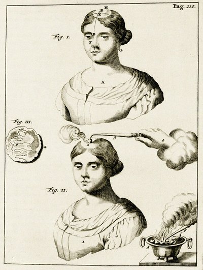 Behandling af en epilepsipatient, fra Øvelser i Lægekunst af Frederik Dekkers, 1694 af Dutch School