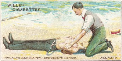 Kunstigt åndedræt, Sylvester