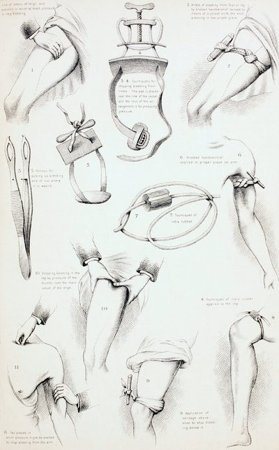 Metoder til at arrestere blødning, ca. 1890 af English School