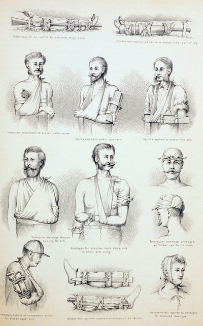 Midlertidig behandling af brud, c.1890 af English School