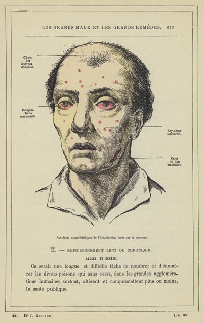 Karakteristiske ulykker med langsom kviksølvforgiftning (farve litho) af French School