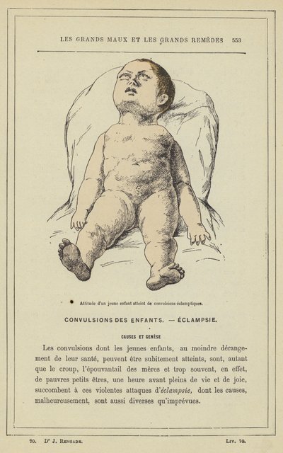 Holdning hos et lille barn med eklamptiske kramper (farve litho) af French School