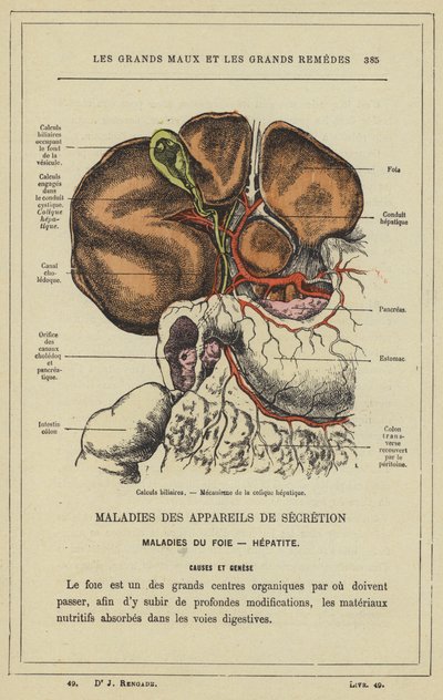 Galdesten, Mekanisme af hepatisk kolik (farve litho) af French School