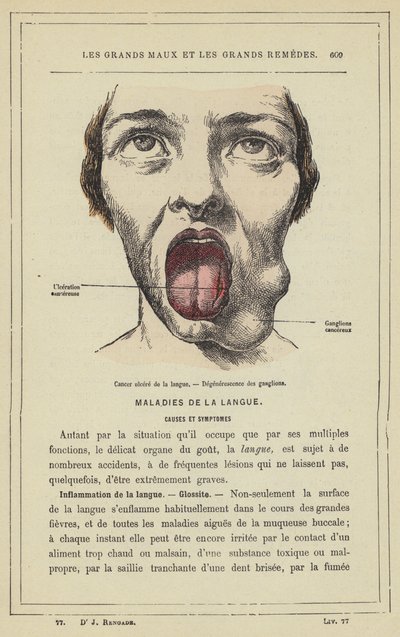Sårkræft i tungen, Degeneration af lymfeknuder (farve litho) af French School