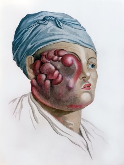Cancerous scrofula, fra Description des Maladies de la Peau af Baron Jean Louis Alibert (1768-1837) Paris, 1806 af French School