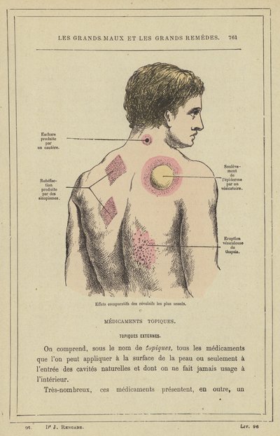 Sammenlignende virkninger af de mest almindelige afskrækningsmidler (farve litho) af French School