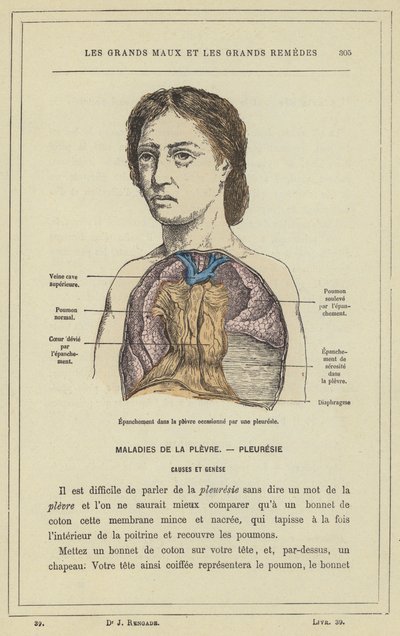 Effusion i lungehinden forårsaget af lungehindebetændelse (farve litho) af French School