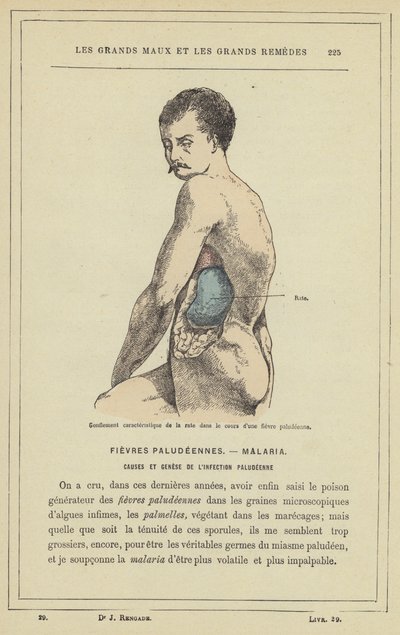 Karakteristisk hævelse af milten i løbet af malariafeber (farve litho) af French School