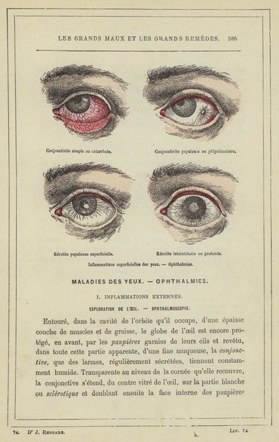 Overfladiske øjenbetændelser, oftalmi (farve litho) af French School