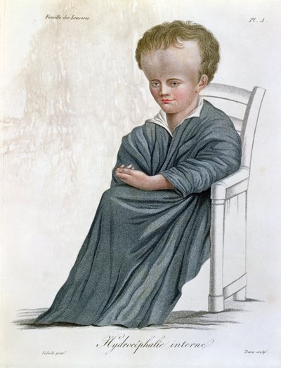 Intern Hydrocephalus, fra Nosologie Naturelle af Baron Jean Louis Alibert (1768-1837) indgraveret af Tresca, 1817 af French School