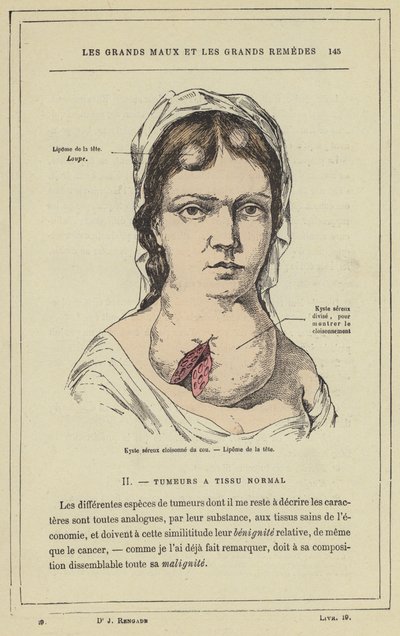 Cloisonne serøs cyste i halsen, Lipoma i hovedet (farve litho) af French School