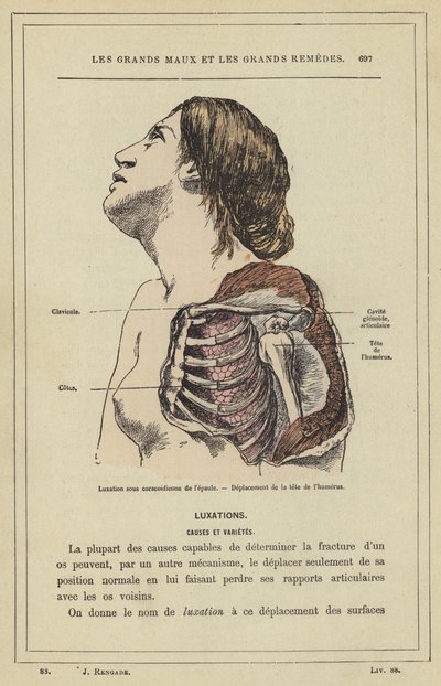 Subcoracoid dislokation af skulderen, forskydning af hovedet på humerus (farve litho) af French School