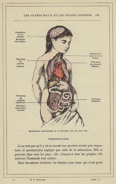 Karakteristiske manifestationer af tuberkulose hos en ung pige (farve litho) af French School