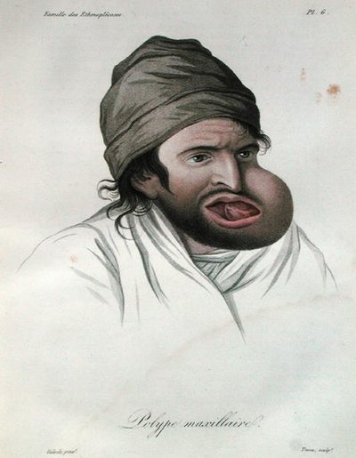 Maxillær polyp, fra en bog af Baron Jean Louis Alibert (1768-1837) 1817 (farvet gravering) af French School