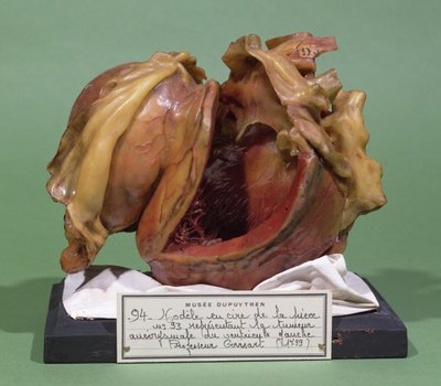 Model af en tumor i venstre ventrikel, 1799 (voks) af French School