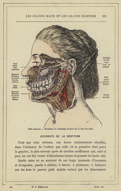 Tandnerver, Mekanisme af odontalgi fremkaldt af huller i tænderne (farve litho) af French School