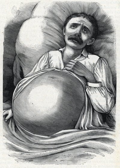 Patient med fremskreden levercirrhose (gravering) 1888 af French School