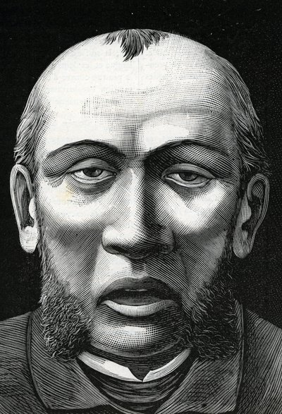 Patient med cerebral blødgøring (gravering) 1888 af French School