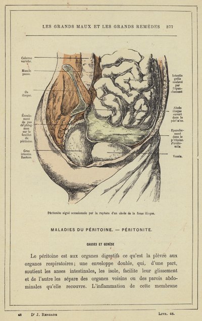 Akut peritonitis forårsaget af ruptur af iliac fossa abscess (farve litho) af French School