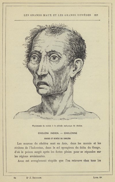Fysiognomi af patienten under asfyksiperioden af ​​kolera (farve litho) af French School