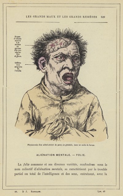 Fysiognomi af et rumvæsen ramt af paral sie generale, i et anfald af raseri (farve litho) af French School