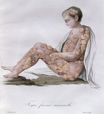 Ringorm, fra en bog af Baron Jean Louis Alibert (1768-1837) 1838 af French School