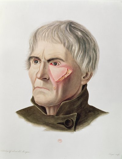 Hudtransplantation, fra Selecta Praxis Medico-Chirurgica af Alexander Auvert, Paris, 1856 af French School