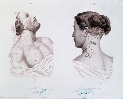 Symptomer på syfilis hos mænd og kvinder, fra en lægebog, ca. 1850-60 af French School