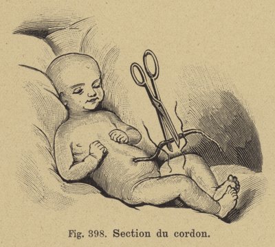 Klipning af en nyfødt babys navlestreng af German School