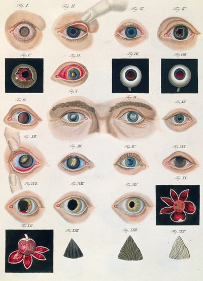 Beskrivelse af medfødte øjenanomalier, fra kliniske præsentationer af sygdomme og visuelle defekter i det menneskelige øje, af Friedrich August von Ammon (1799-1861) 1838 af German School