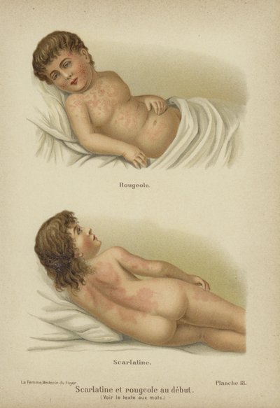 Tidlige symptomer på mæslinger og skarlagensfeber (farve litho) af German School