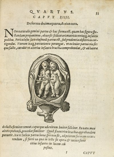 Ikke-identiske tvillinger i livmoderen, illustration fra kapitel 14, bog 4 i Om undfangelse og vækst af mennesket af Rueff, 1587 af German School