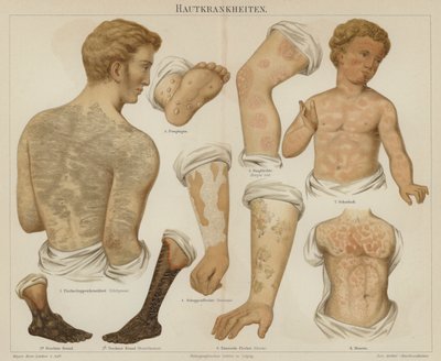 Hudlidelser (farve litho) af German School