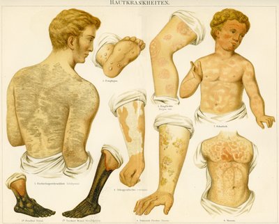 Hudlidelser, ca. 1890 af German School