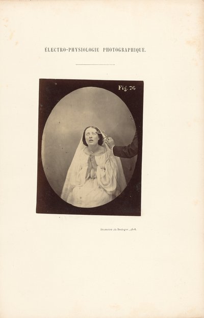 Fotografisk elektrofysiologi, figur 76 af Guillaume Benjamin Duchenne