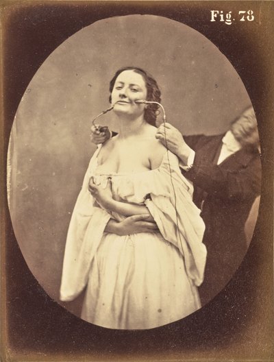 Fig. 78 af Guillaume Benjamin Duchenne