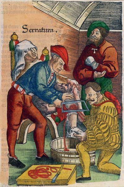 En amputation, illustration fra 