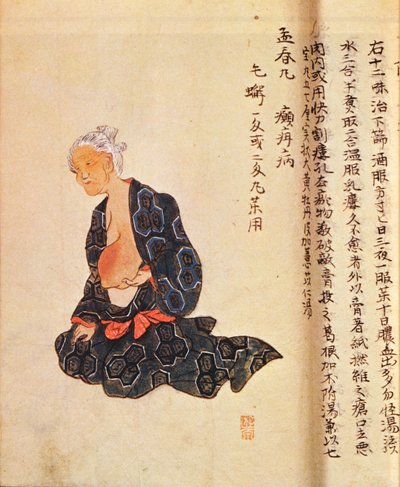 Den første kirurgiske behandling af brystkræft udført under generel anæstesi af Seishu Hanaoka (1760-1836) i 1804 af Japanese School
