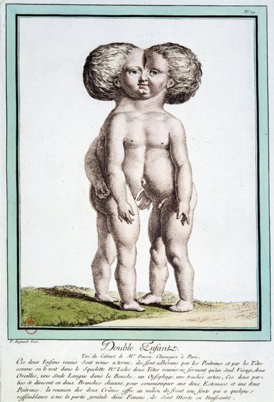 Siamesiske børn - i "" Naturens afvigelser"" af Régnault af Jean Baptiste Regnault