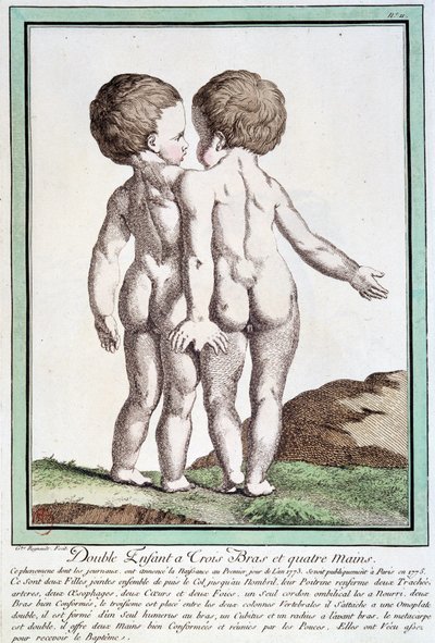 Siamesiske børn - i "" Naturens afvigelser"" af Régnault af Jean Baptiste Regnault